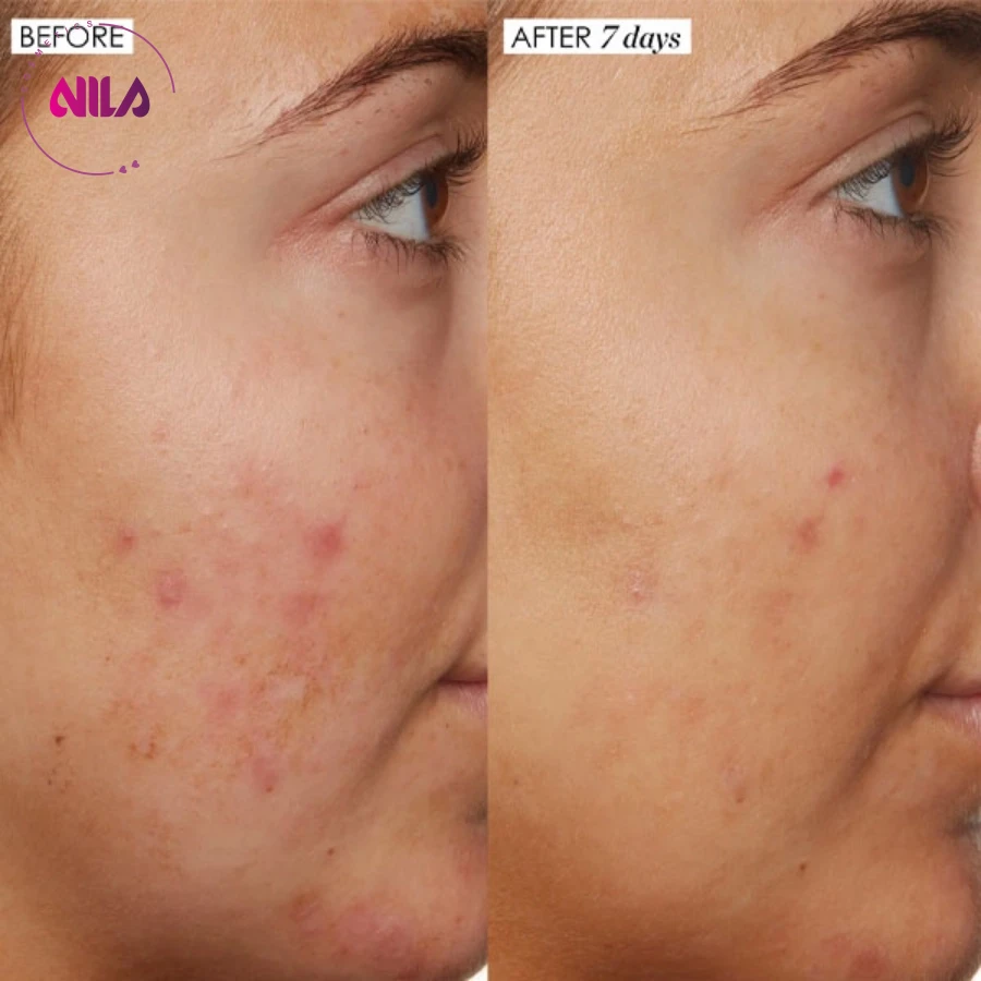 سرم ضد جوش نیاسینامید 10% + زینک 1% اوردینری اصل